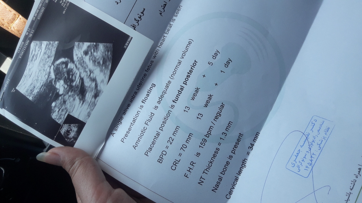 سنو گرافی غربالگری اولی NT