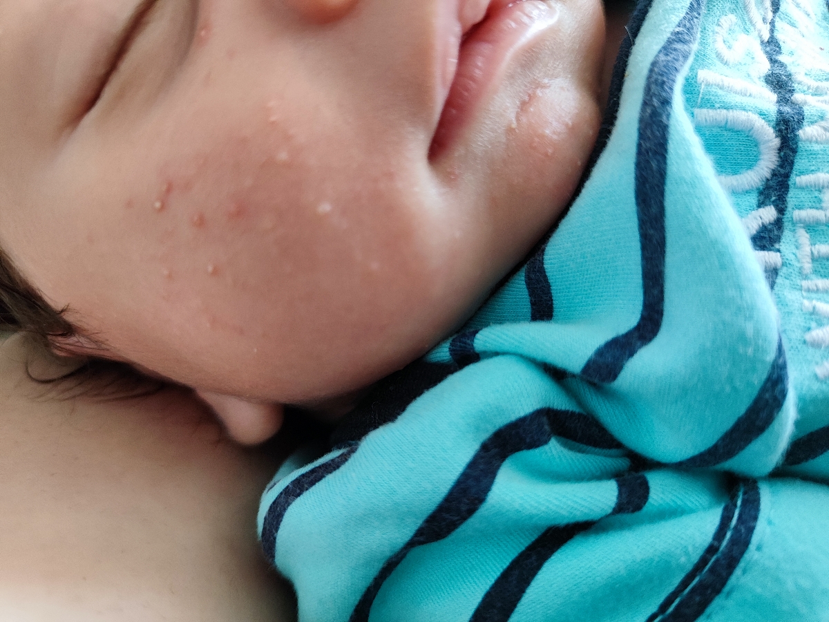 حساسیت صورت نوزاد ۱ماهه حساسیت صورت نوزاد ۱ماهه