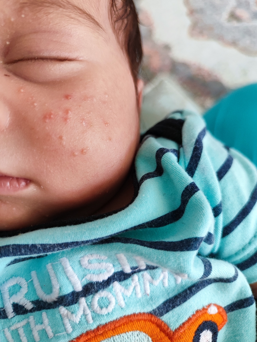 حساسیت صورت نوزاد ۱ماهه حساسیت صورت نوزاد ۱ماهه