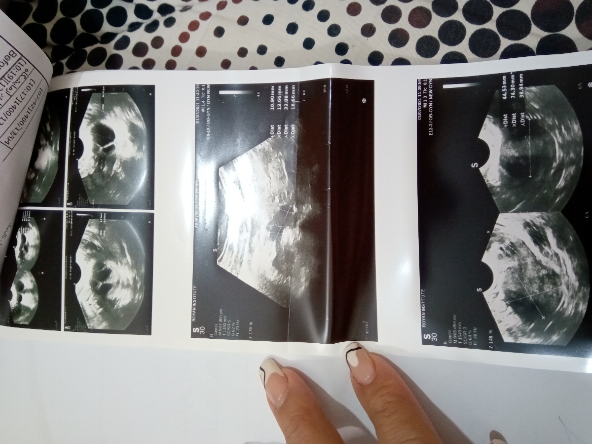 رفع تنبلی تخمدان وضعف اسپرم همسر