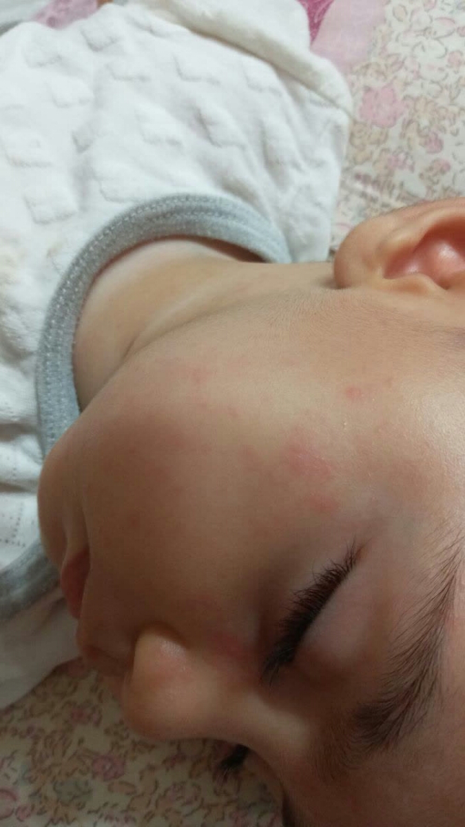 تب شدید نوزاد و بیماری رزوئلا