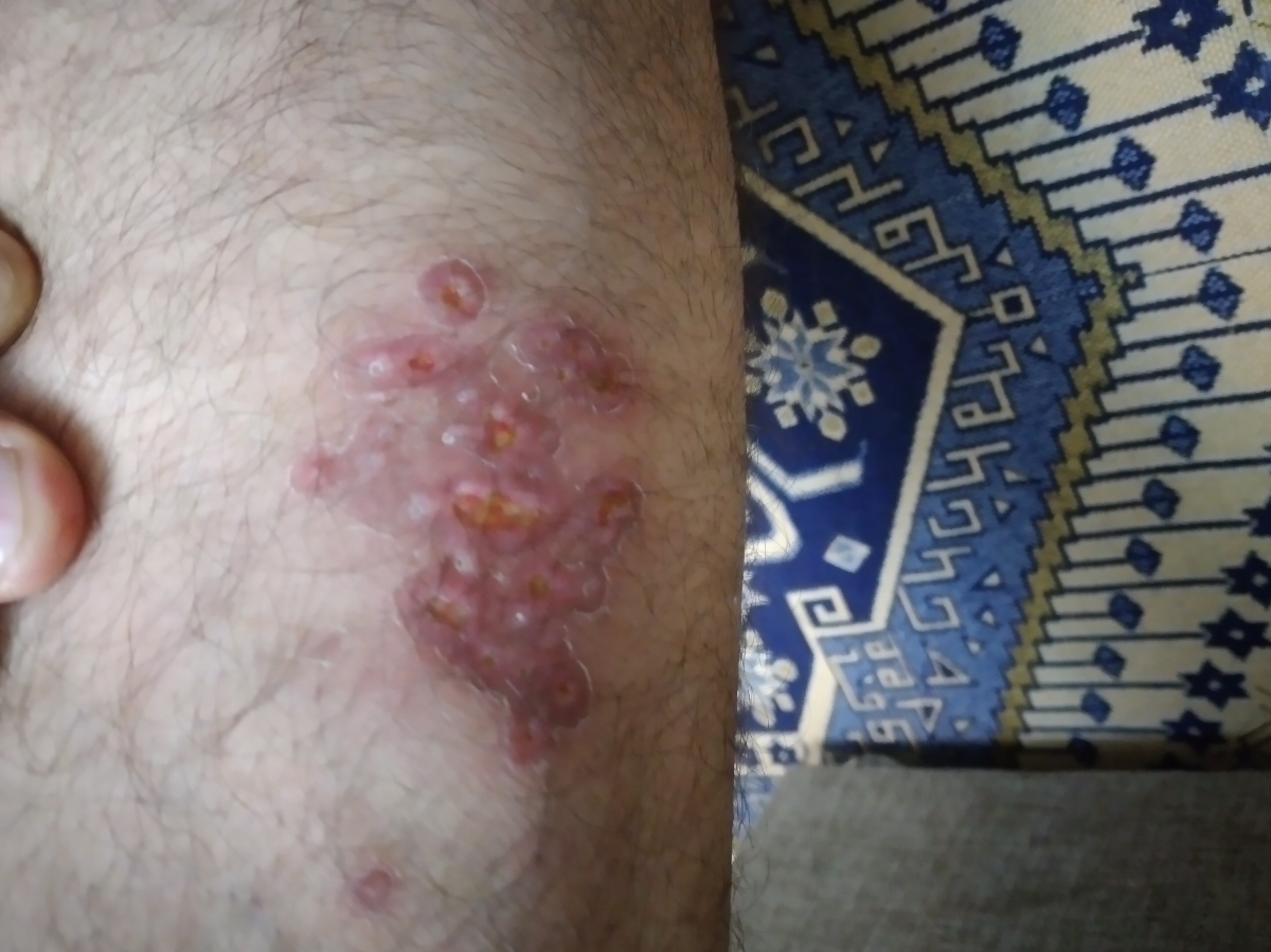 جای حشره سالک جای حشره سالک