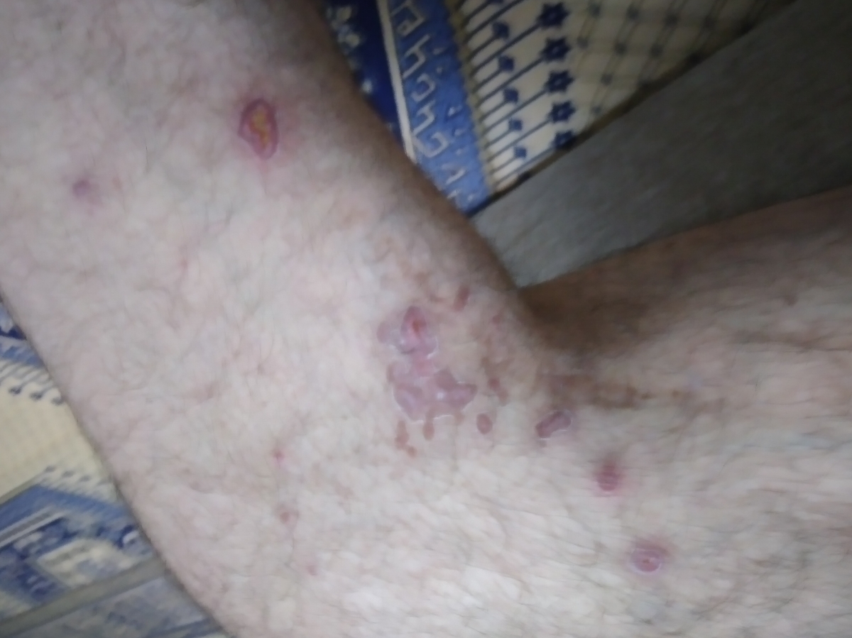 جای حشره سالک جای حشره سالک