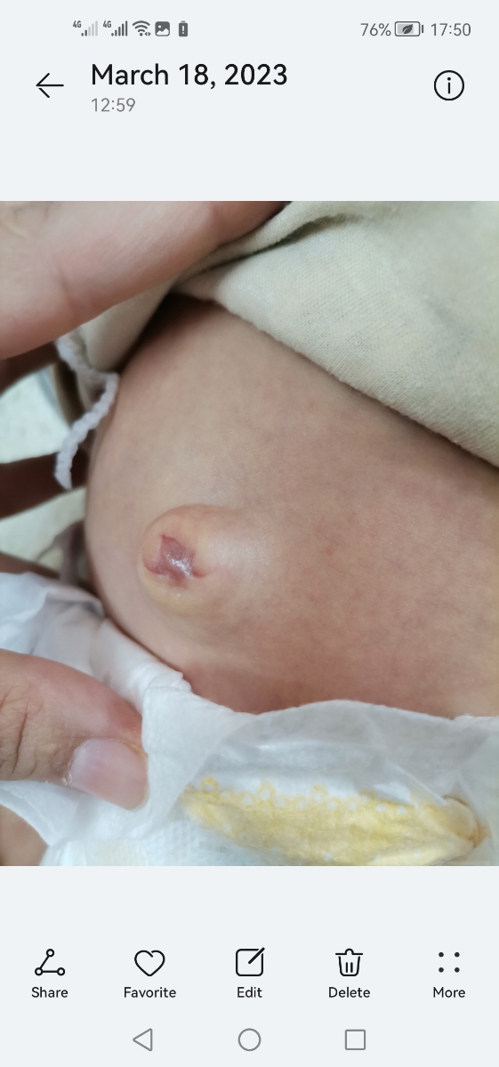 زور زدن موقع مدفوع کردن نوزاد