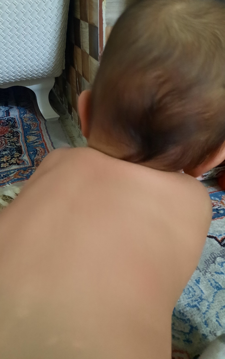 قرمز شدن یهویی بدن کودک