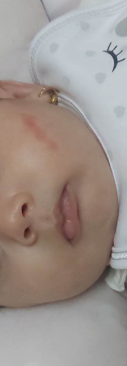 قرمزی رو صورت نوزاد ماه گرفتگیه؟؟ قرمزی رو صورت نوزاد ماه گرفتگیه؟؟