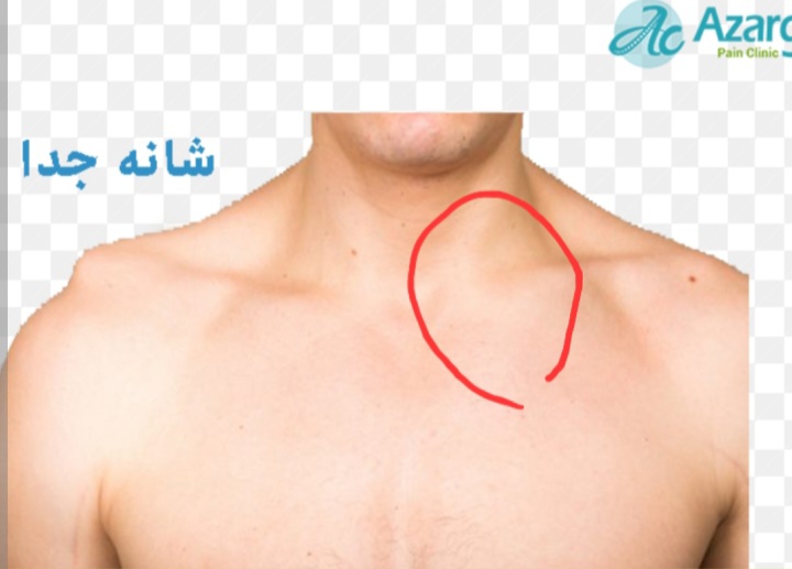 مشکل در بلع و ورم استخوان ترقوه