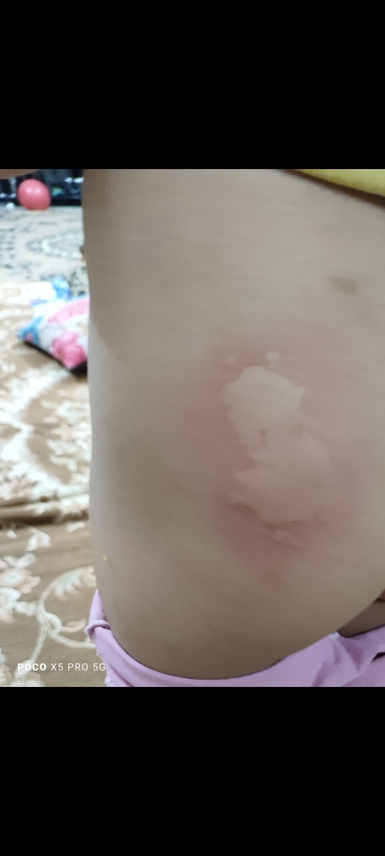این چیه پشت دخترم؟از خواب بیدار شد خارش داشت این چیه پشت دخترم؟از خواب بیدار شد خارش داشت