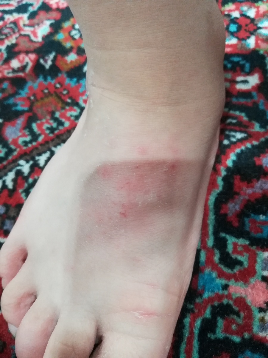 اگزما و خارش پوست پسر4ساله