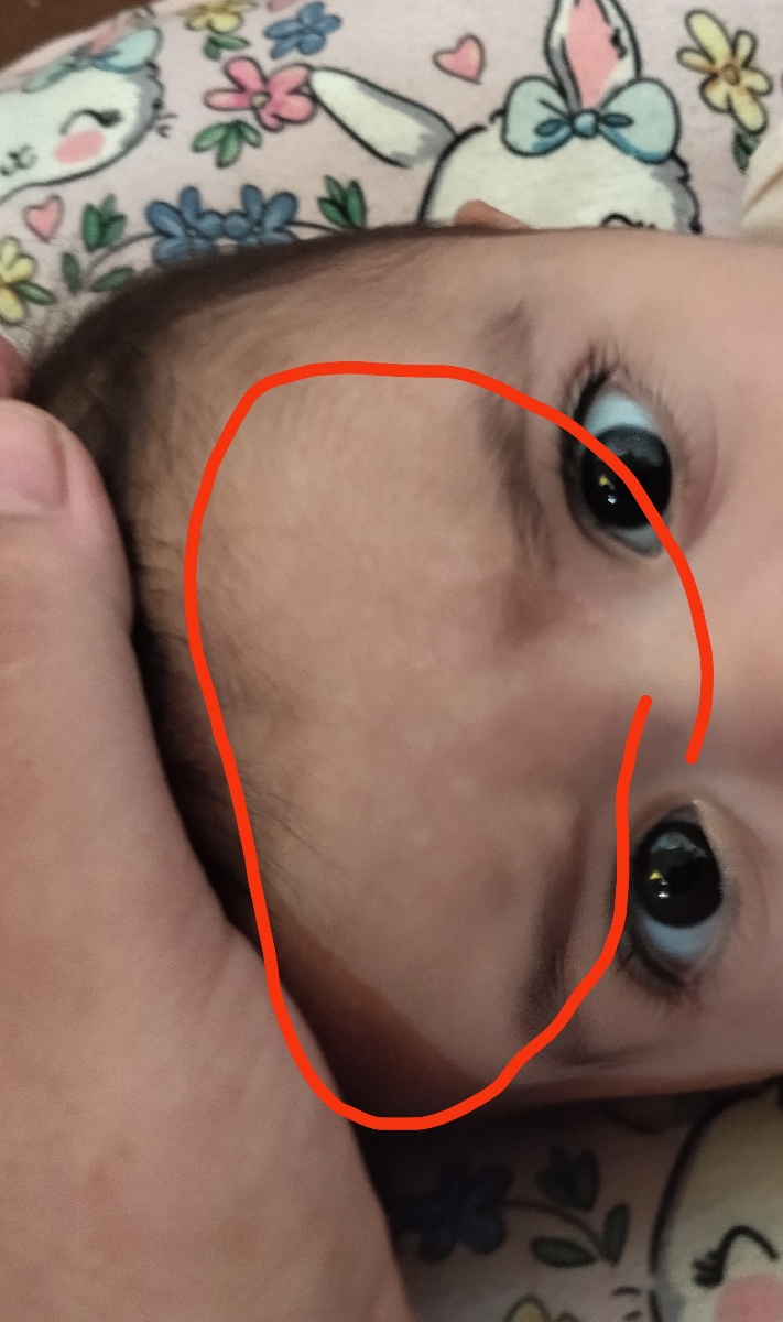 سلام خانم دکتر عزیز یه چند روزی میشه پوست قسمت پیشانی دخترم این شکلی سلام خانم دکتر عزیز یه چند روزی میشه پوست قسمت پیشانی دخترم این شکلی