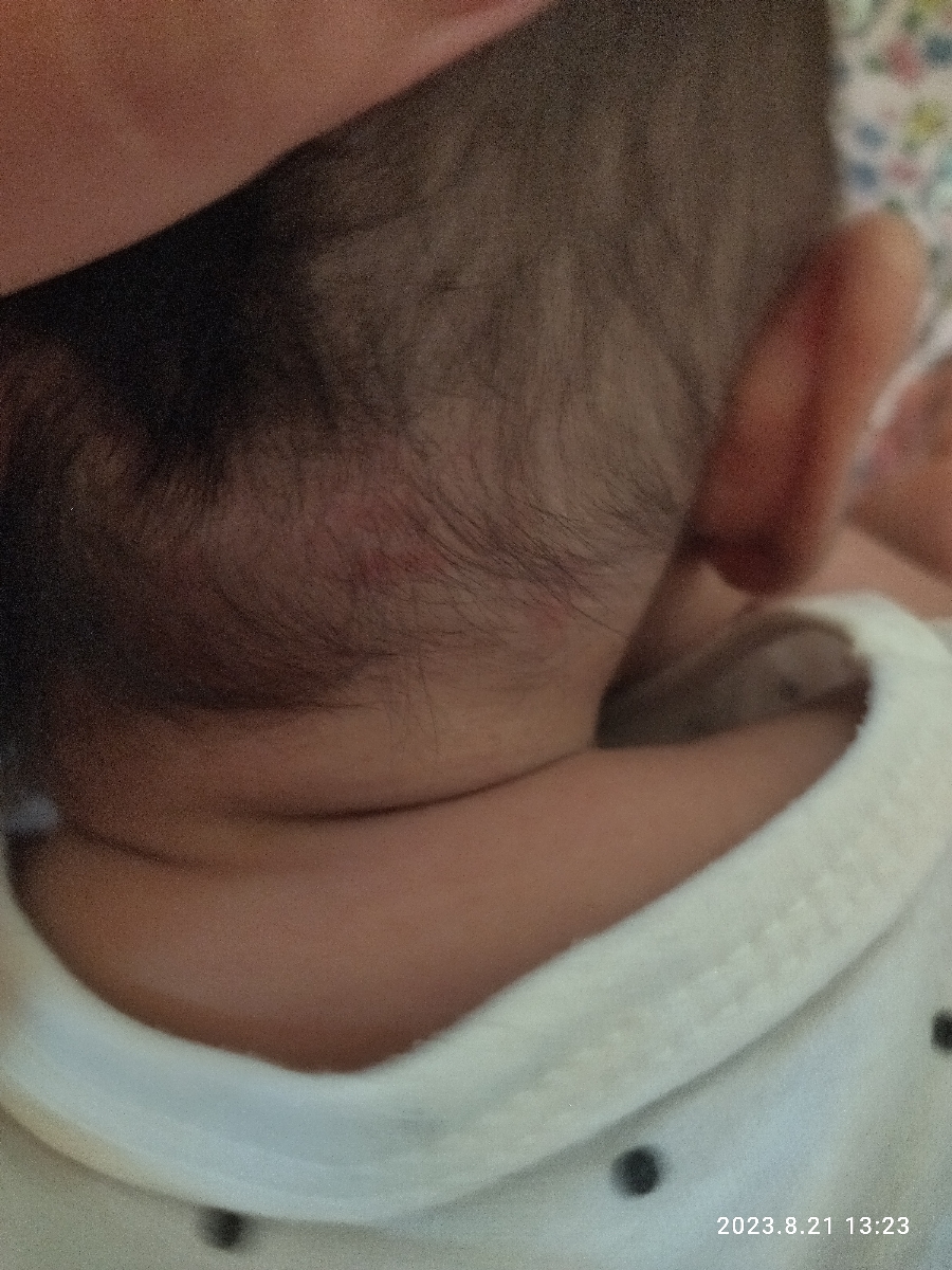 سلام خانم دکتر عزیز یه چند روزی میشه پوست قسمت پیشانی دخترم این شکلی سلام خانم دکتر عزیز یه چند روزی میشه پوست قسمت پیشانی دخترم این شکلی