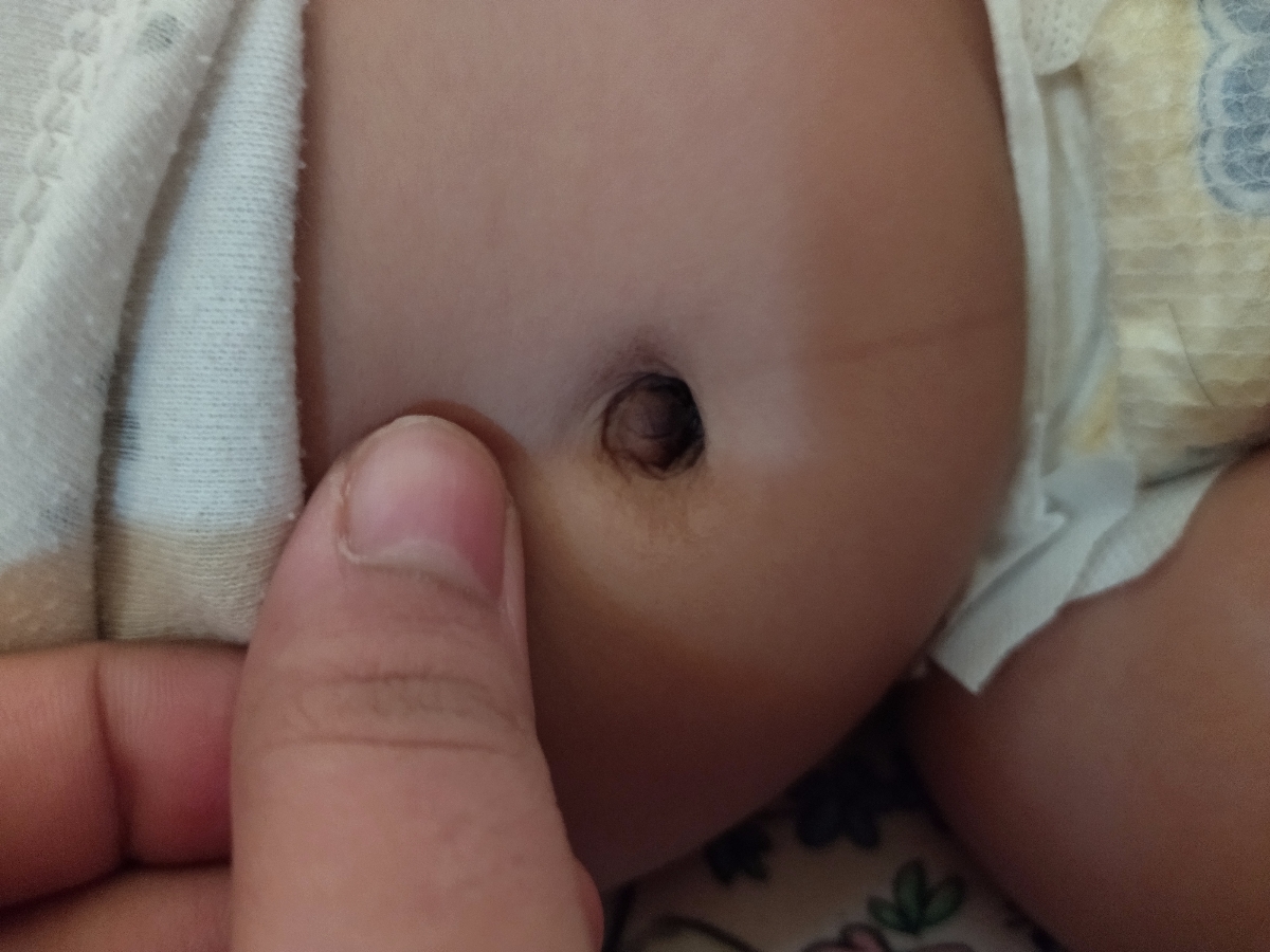 سلام خانم دکتر عزیز یه چند روزی میشه پوست قسمت پیشانی دخترم این شکلی سلام خانم دکتر عزیز یه چند روزی میشه پوست قسمت پیشانی دخترم این شکلی