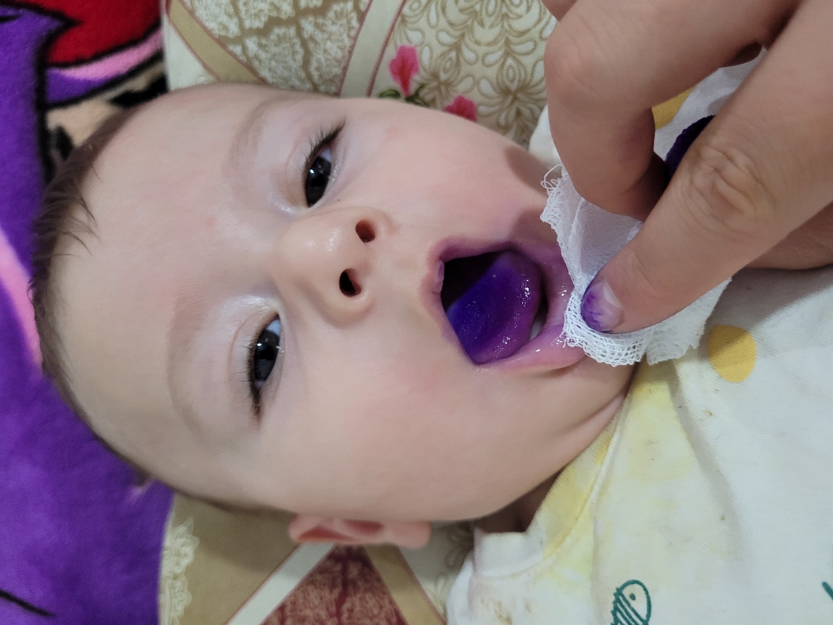 آفت دهان نوزاد ۴ماهه آفت دهان نوزاد ۴ماهه