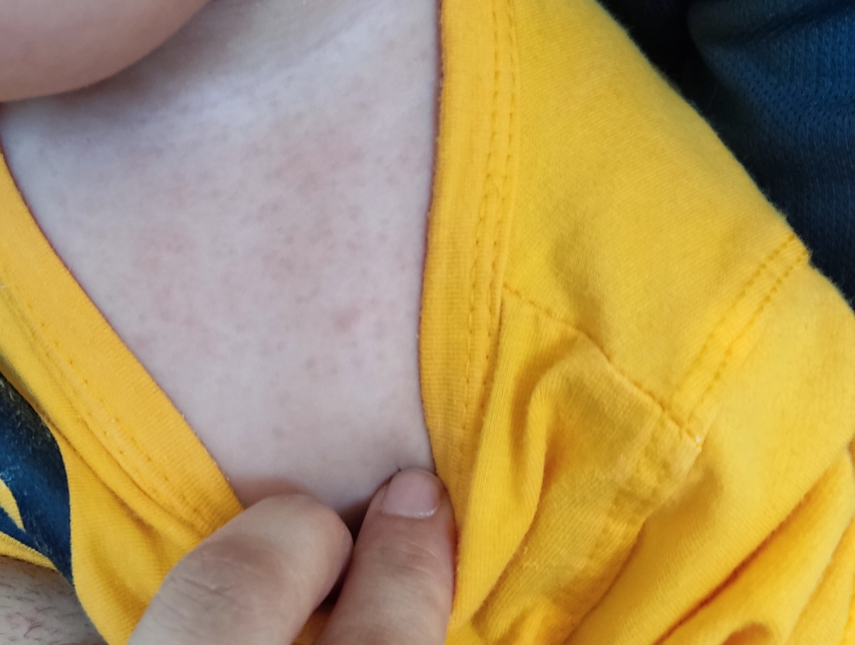 جوش زدن گردن و باسن نوزاد ۷ ماهه