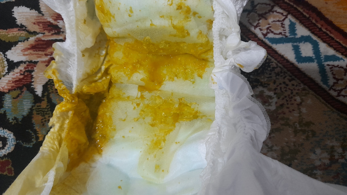 آزمایش مدفوع نوزاد