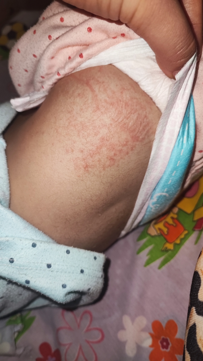 دونه ریز روی باسن کودک دونه ریز روی باسن کودک
