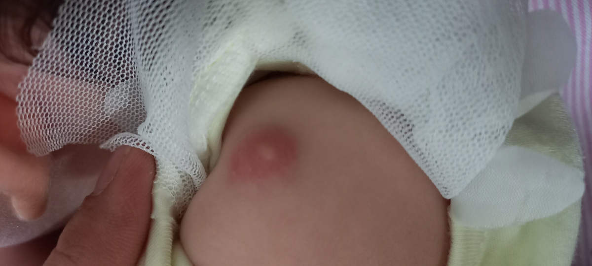 جای زخم واکسن بازو جای زخم واکسن بازو