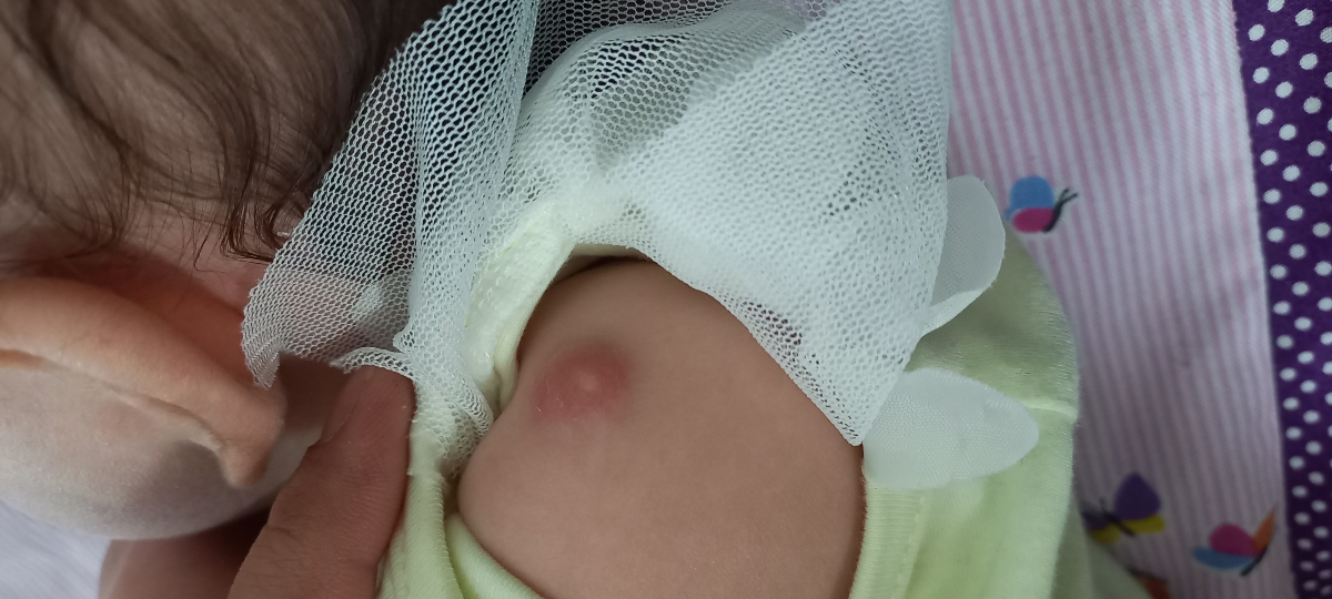 جای زخم واکسن بازو جای زخم واکسن بازو