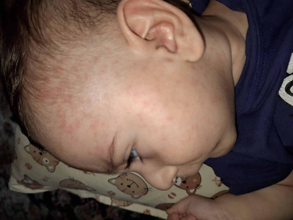 بچم شیر نمیخوره بدنش دونه پاچیده بچم شیر نمیخوره بدنش دونه پاچیده
