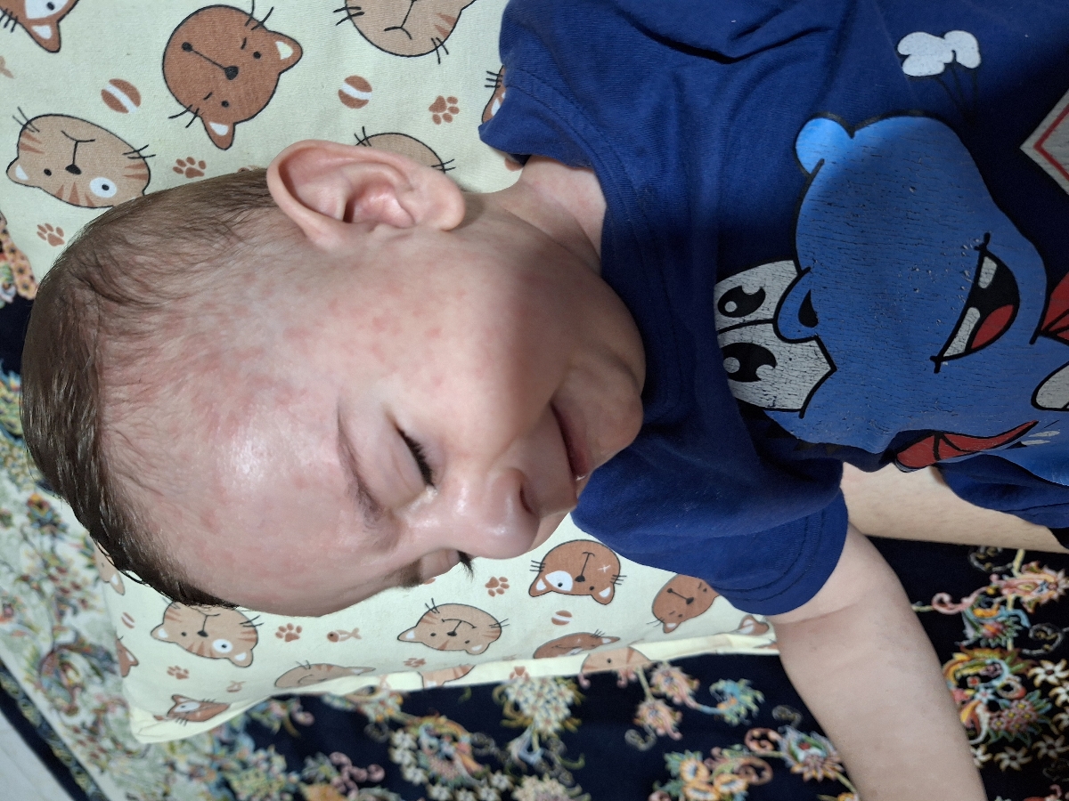 بچم شیر نمیخوره بدنش دونه پاچیده بچم شیر نمیخوره بدنش دونه پاچیده