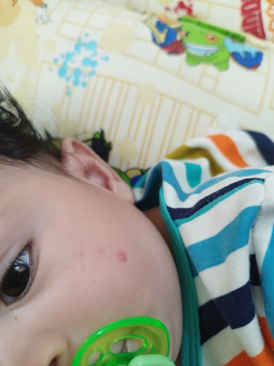 جوش زدن نوزاد ۵ ماهه