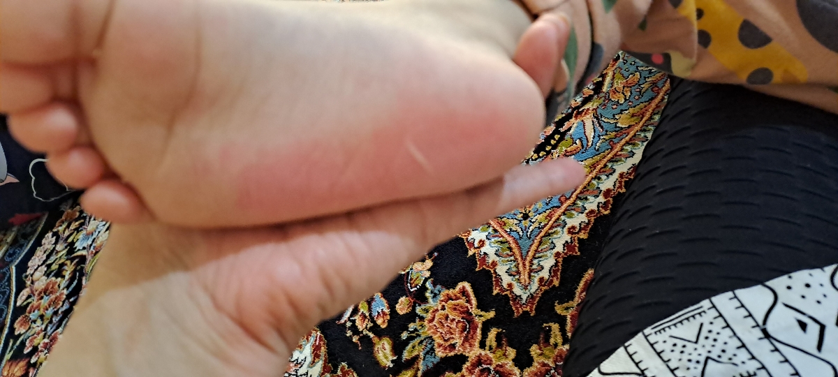 سوختگی پای کودک ۲۱ ماهه