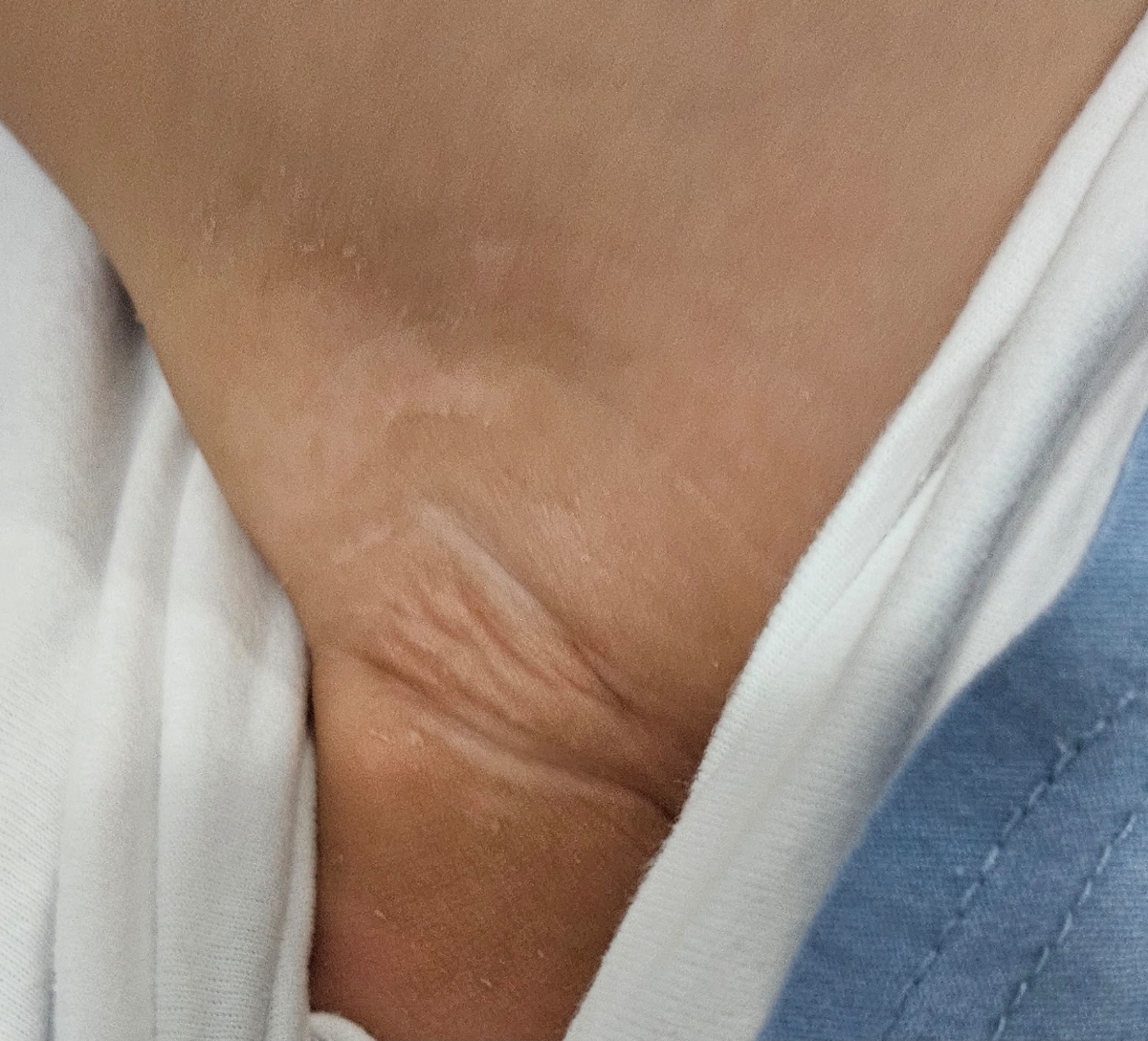 علائم اگزما در کودک ۸ ماهه