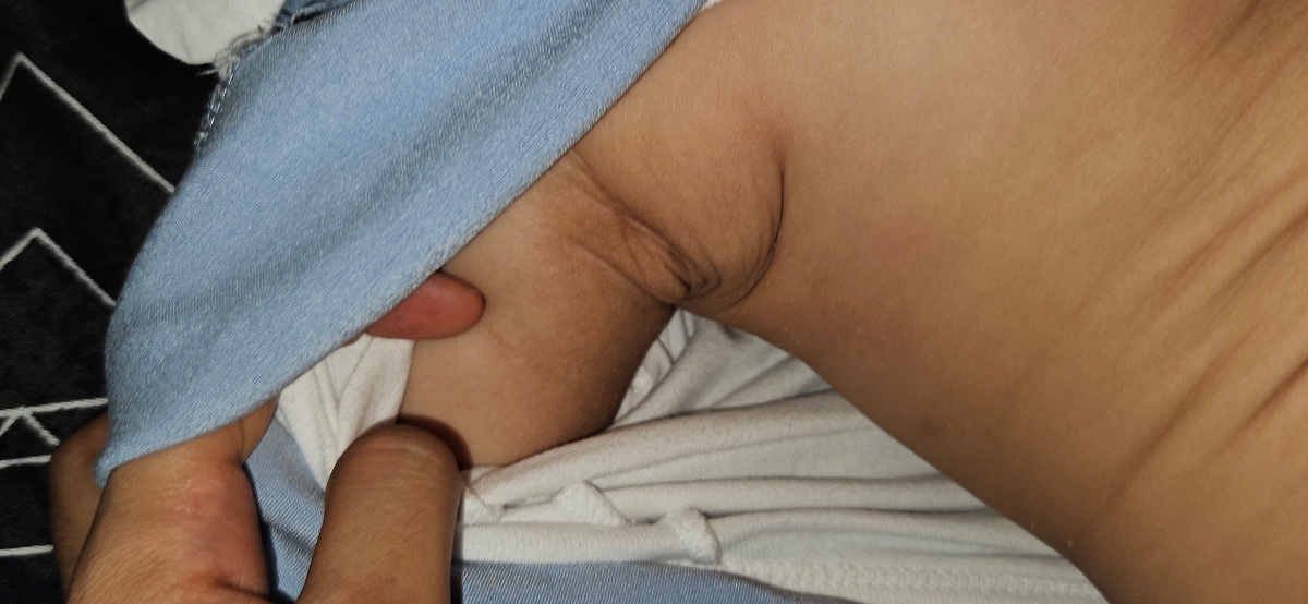 علائم اگزما در کودک ۸ ماهه