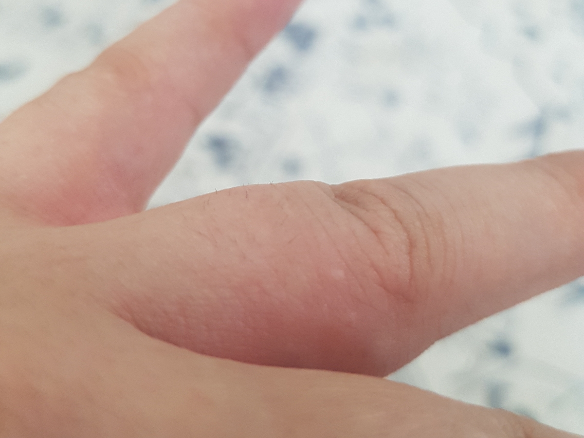 جوش های آبدار ریز بین انگشتان دست که میخاره جوش های آبدار ریز بین انگشتان دست که میخاره