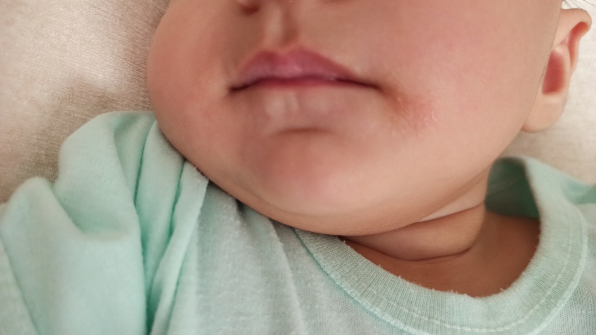 جوش زدن کنار لب نوزاد ۷ماه