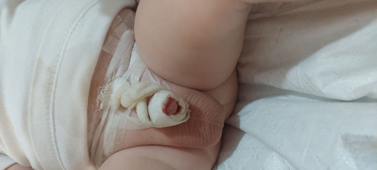 ختنه ب روش سنتی و تاول سر آلت شیرخوار