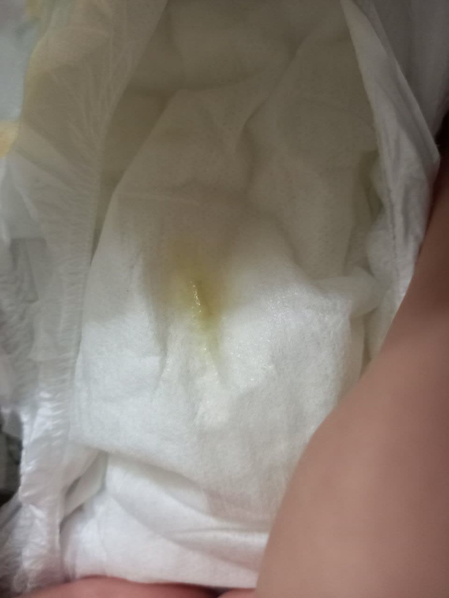 اورژانسی ترشح تو موشک نوزاد ۳ماهه