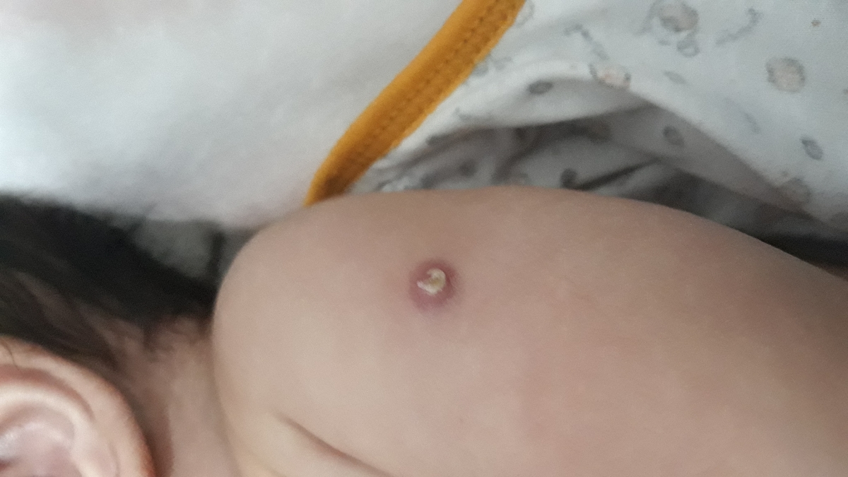 قرمزی محل واکسن نوزاد
