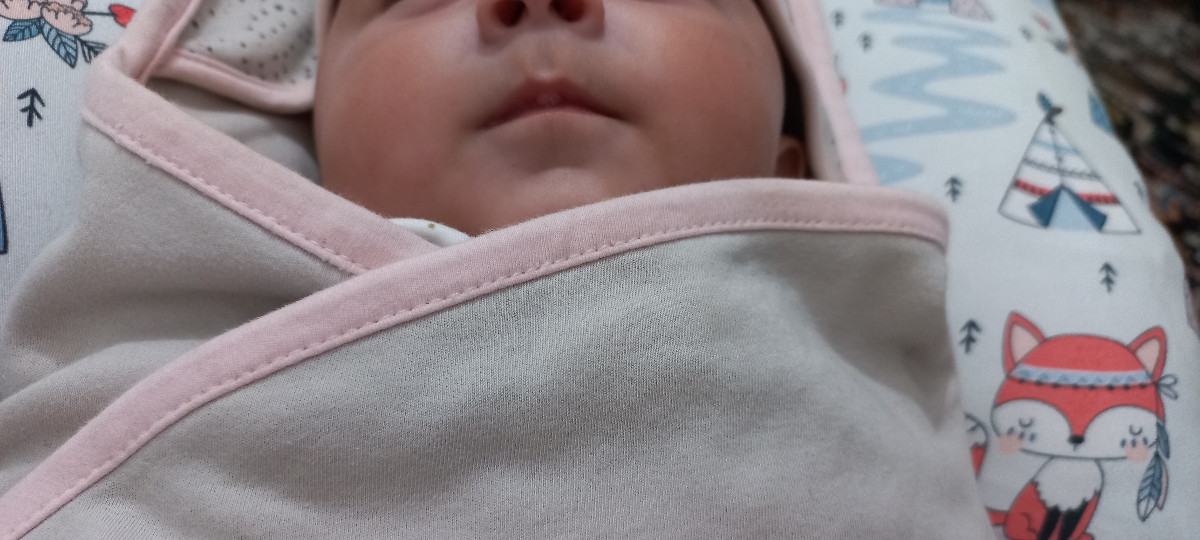 اگزما پوستی صورت نوزاد