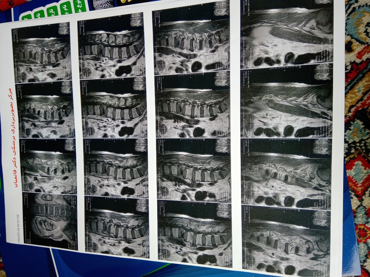 رفع تنبلی تخمدان وضعف اسپرم همسر