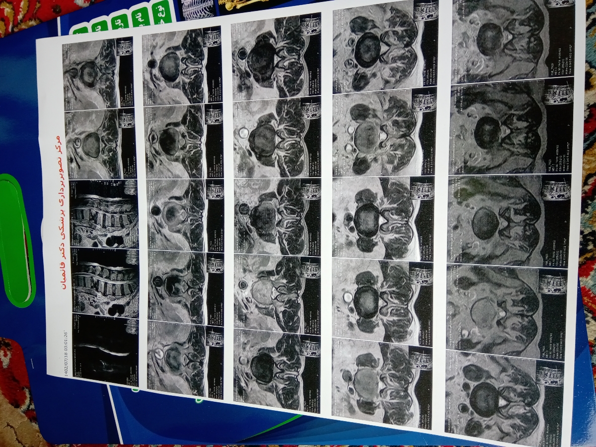 رفع تنبلی تخمدان وضعف اسپرم همسر