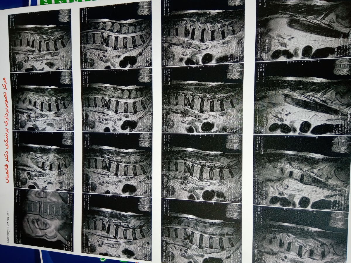 رفع تنبلی تخمدان وضعف اسپرم همسر