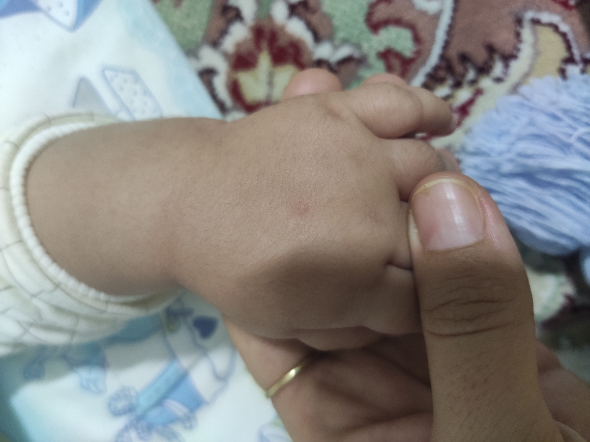 این جوش ها آبله مرغان هست یا نه