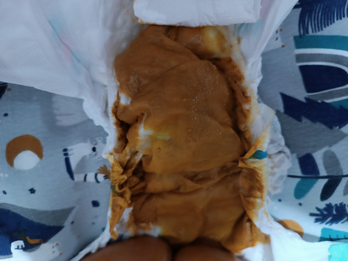 شل شدن مدفوع نوزاد شل شدن مدفوع نوزاد