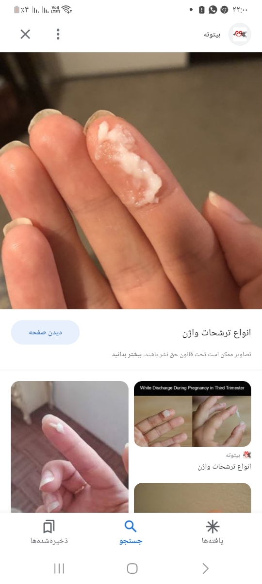 ترشحات واژن دختر ۱ سال و ده ماهه