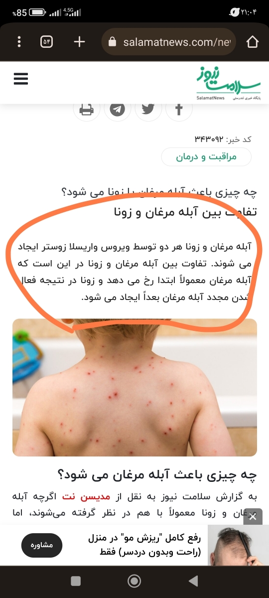 سلام عزیزم در مورد ویروس زونا