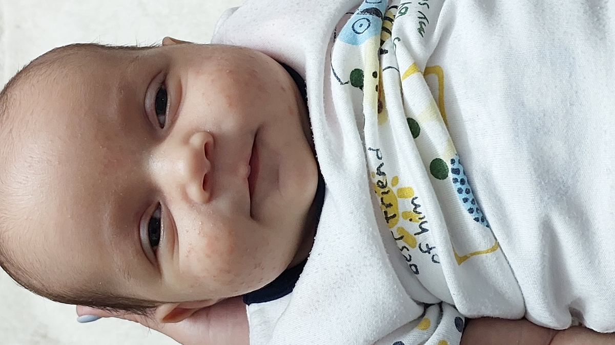 جوش سرسفید وزیادروپوست صورت نوزاد۱۹روزه +عکس جوش سرسفید وزیادروپوست صورت نوزاد۱۹روزه +عکس