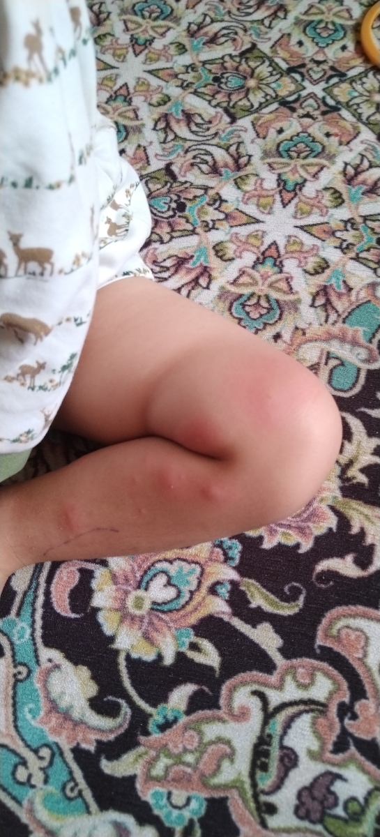 جای نیش حشره روی بدن نوزاد