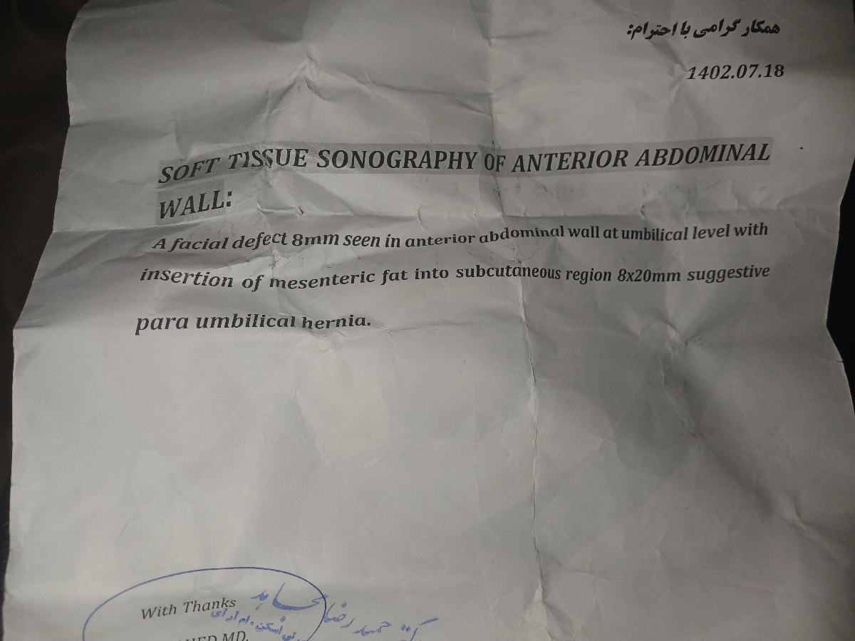 فتق ناف کودک ۱ سال و۶ ماهه