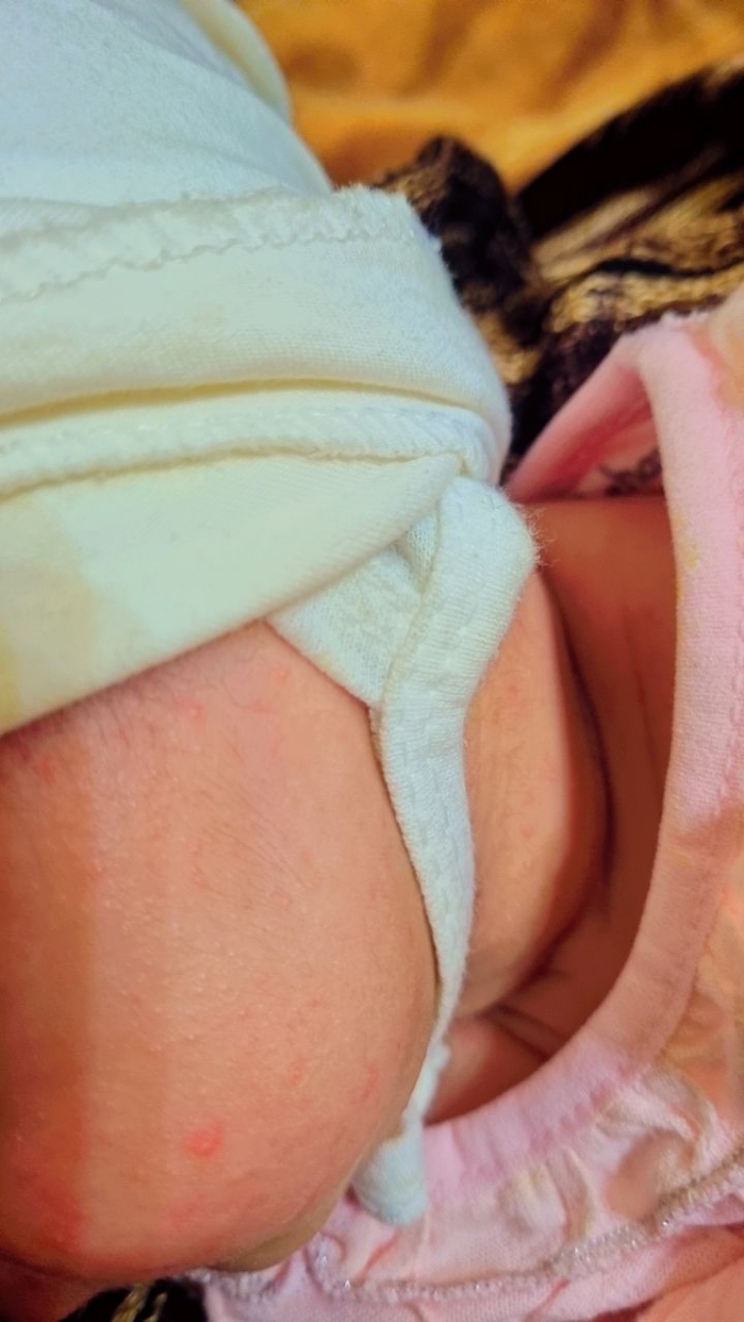 جوش سر سفید روی صورت و گردن دخترم