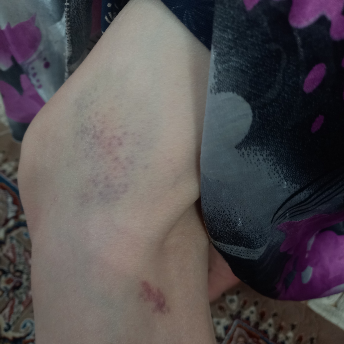 خانم دکتر مامانم میگه هر دفع بدنم اینجور کبود میشه