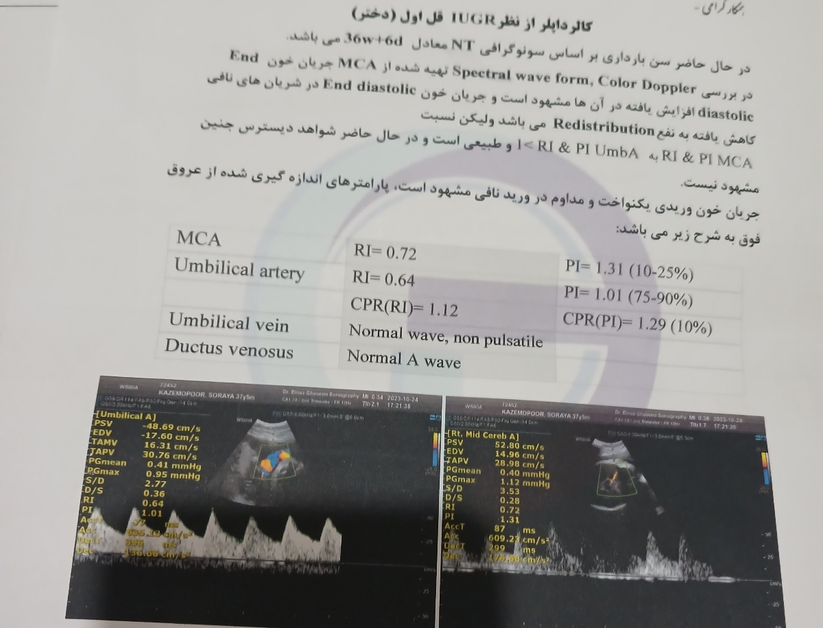 رشد جنین در۳۶هفته و۶روز طول فمور وهومروس کمتر ازصدک۵