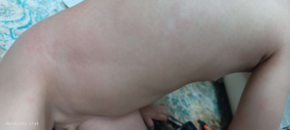 صورت پسرم قرمز شده