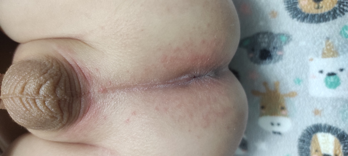 علت قرمز شدن دور مقعد چیست