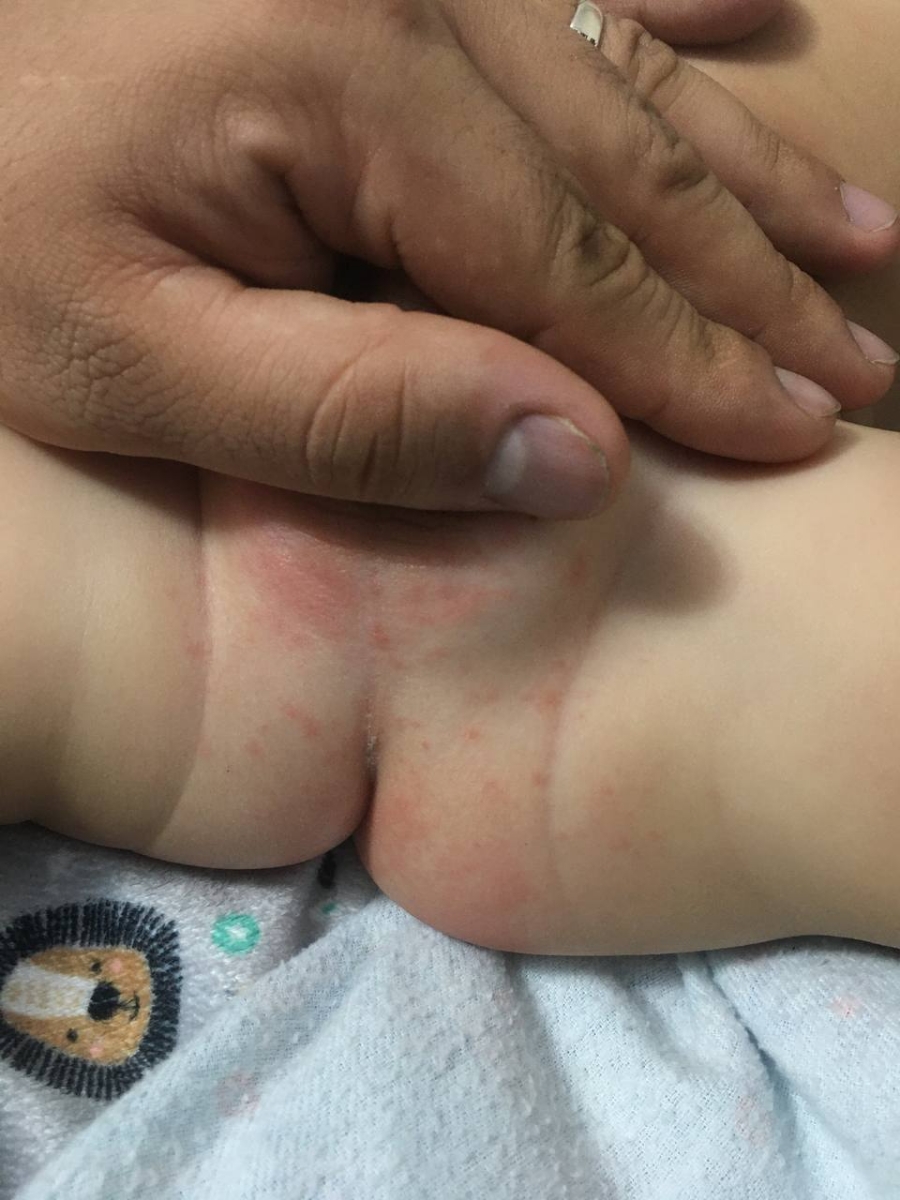 علت قرمز شدن دور مقعد چیست